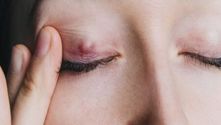 Küçük Ama Can Sıkan Göz Kapağında Yağ Bezesi 