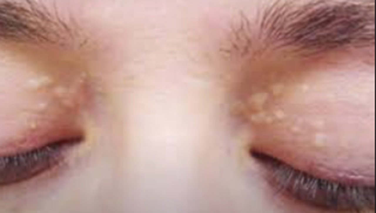 goz-kapaginda-yag-bezesi